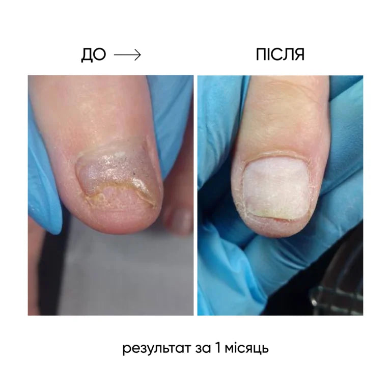 NAILSOFTHEDAY Onistop - regenerating oil against onycholysis
