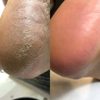 NAILSOFTHEDAY Podology+ Keratolytic for feet, urea 20%, 100 ml