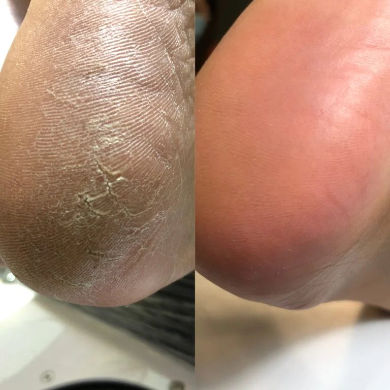 NAILSOFTHEDAY Anti crack cream, urea 12%, 30 ml