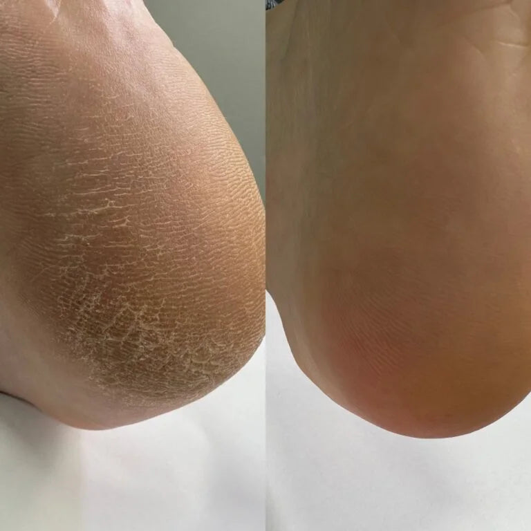NAILSOFTHEDAY Podology+ Keratolytic for feet, urea 20%, 100 ml