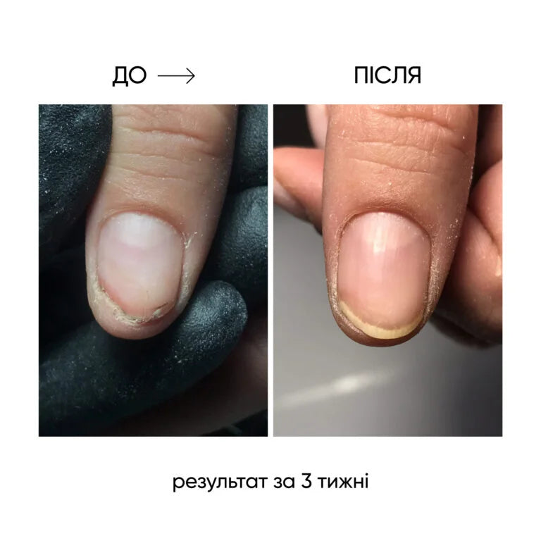 NAILSOFTHEDAY Onistop - regenerating oil against onycholysis