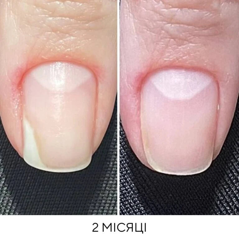 NAILSOFTHEDAY Onistop - regenerating oil against onycholysis