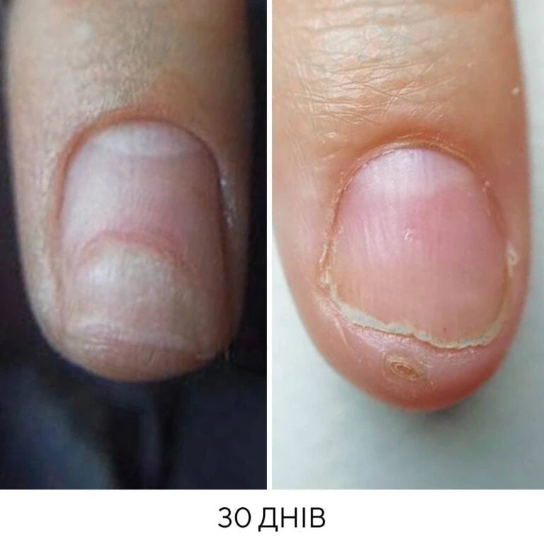 NAILSOFTHEDAY Onistop - regenerating oil against onycholysis
