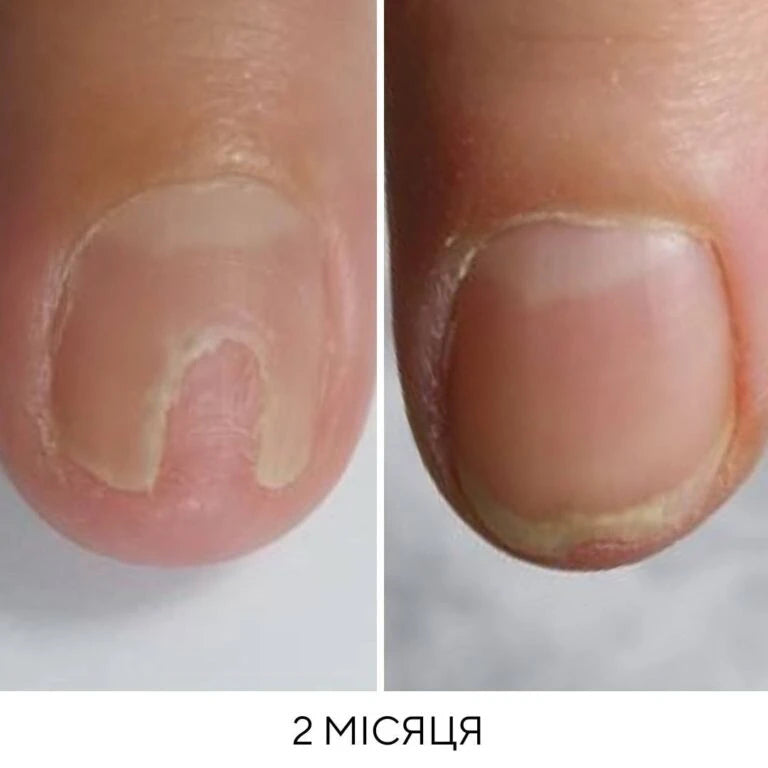 NAILSOFTHEDAY Onistop - regenerating oil against onycholysis
