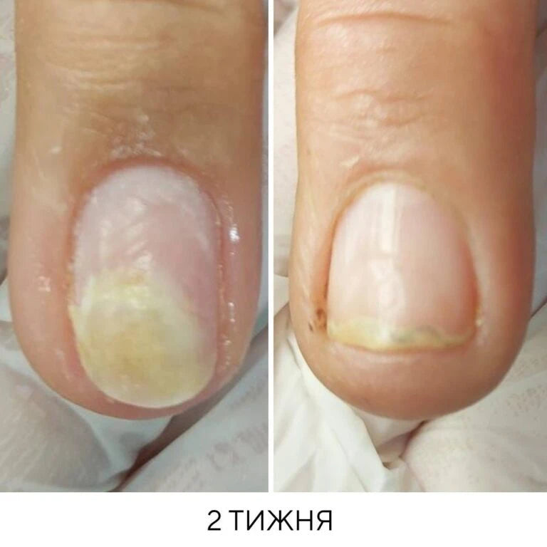 NAILSOFTHEDAY Onistop - regenerating oil against onycholysis