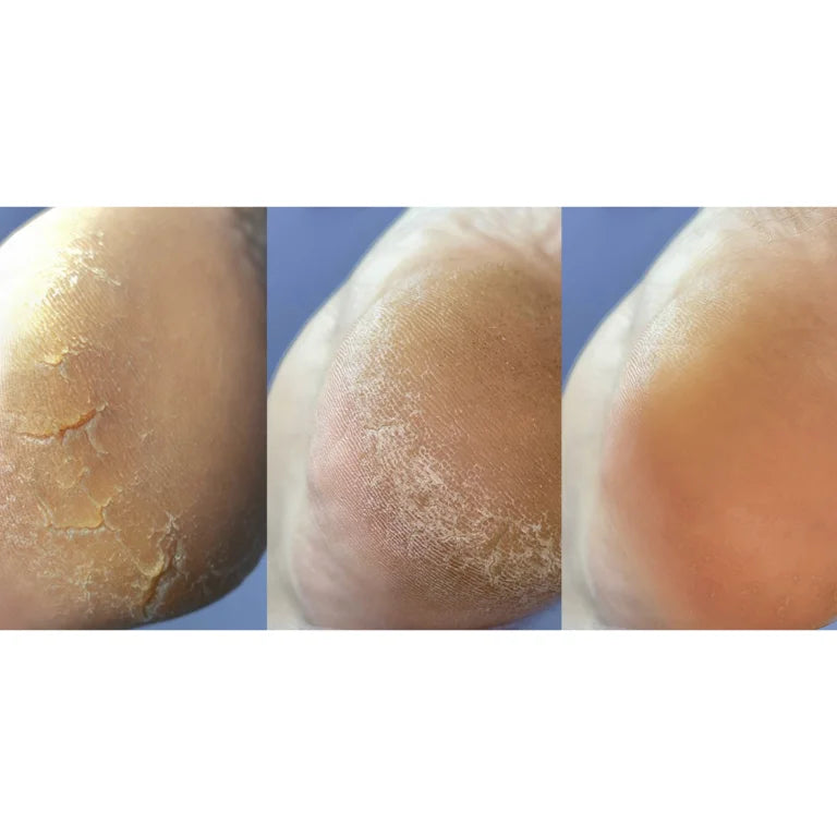 NAILSOFTHEDAY Anti crack cream, urea 12%, 30 ml