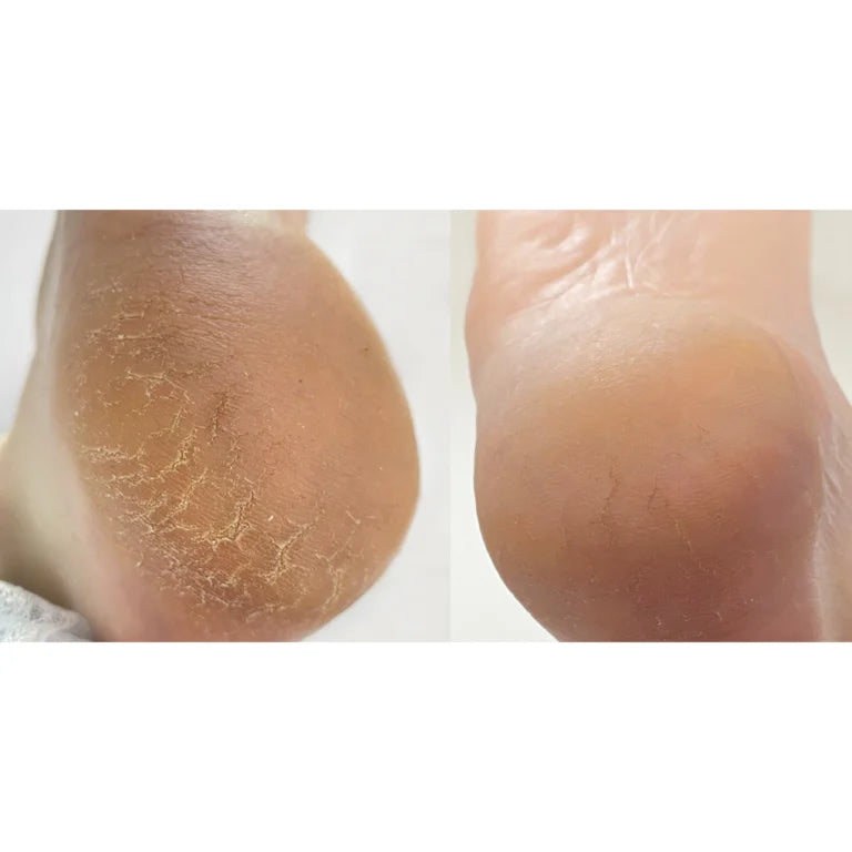 NAILSOFTHEDAY Anti crack cream, urea 12%, 30 ml